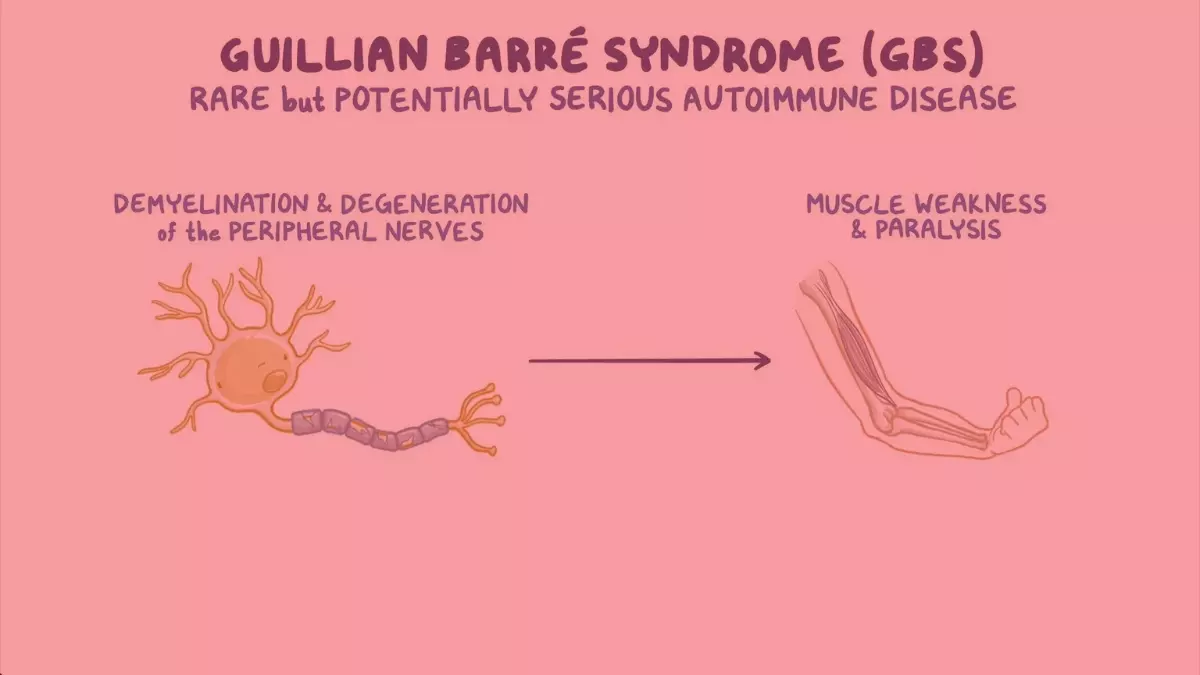 Telangana woman diagnosed with GBS disease, first known case in state