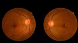 Eye’s retina offers non-invasive stroke risk prediction: study