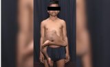 AIIMS Doctors Conduct Surgery On Boy With 2 Extra Feet Attached To Stomach