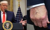 Another Bruise On Trump's Hand? Pic Sparks Concern Days After Mark On Hand